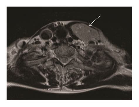 Preoperative Imaging Findings For Case 1 A Contrast Enhanced