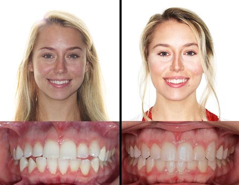 Invisalign St Louiss Invisalign Expertmoshiri Orthodontics