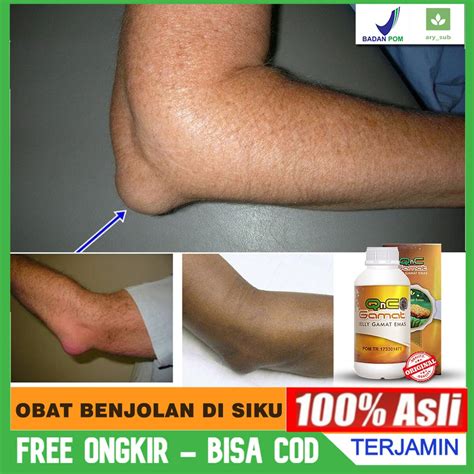 Jual Obat Benjolan Di Siku Kiri Kanan Benjolan Di Tangan Kista