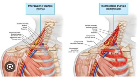 Thoracic Outlet Syndrome Causes Symptoms And Treatment Methods Assoc Prof Dr Murat Akkuş