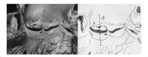 The Aorta 1 Opened To Show The Aortic Valve 2 The Sinotubular