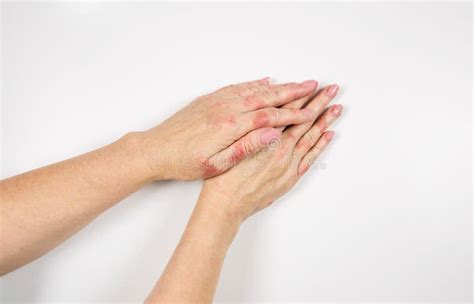 Eczema En Las Manos Manos Femeninas Afectadas Por La Dermatitis Cierre