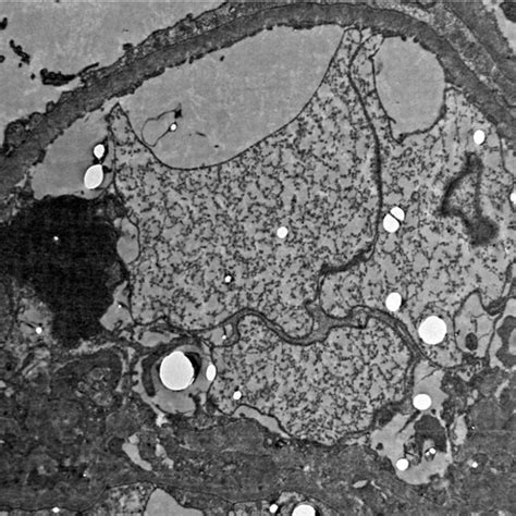 Case 1 -Electron microscopy (glomerulus image) | Download Scientific ...