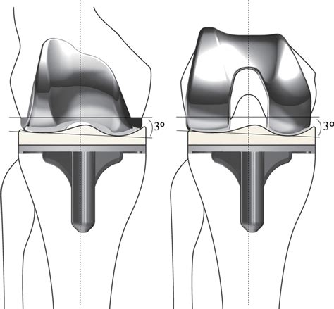 The FINE Total Knee The Femoral Condyle Has An Asymmetric Shape And