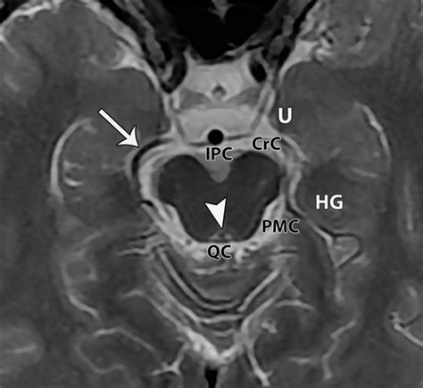 Types Of Cerebral Herniation And Their Imaging Features Radiographics