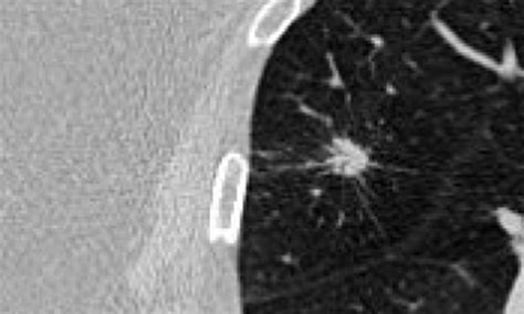 Robotic Bronchoscopy Lung Nodule Biopsy Norton Healthcare Provider