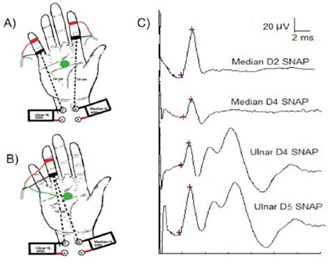 Clinical And Electrophysiological Evaluation Of Carpal Tunnel Syndrome Approach And Pitfalls