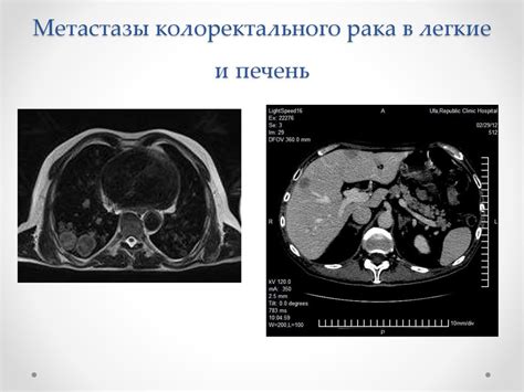 Рак Желудка С Метастазами В Легкие