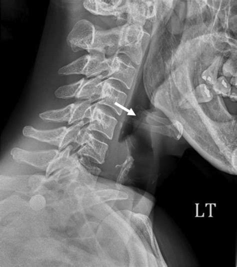 Lateral Soft Tissue Neck Radiograph Showing A Lobulated Enlarged Download Scientific Diagram