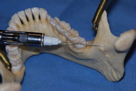 Long Buccal Nerve Block