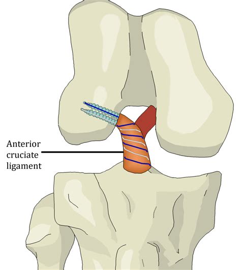 Internal Brace Ligament Augmentation Utilized in Anterior Cruciate ...