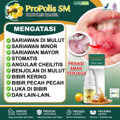 Jual Obat Sariawan Di Mulut Sariawan Minor Sariawan Mayor Stomatis