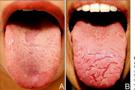 Figure From A Clinical Study Of Cases Of Geographic Tongue