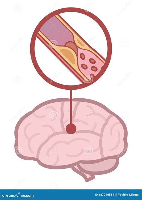 Brain Stroke Cerebral Infarction Illustration Stock Vector