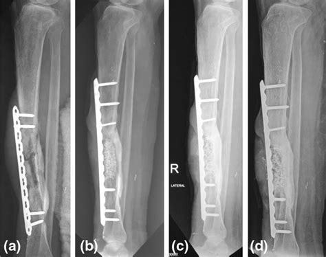 Tibial Radiography Of Subject B A Preoperative Tibial Radiography B