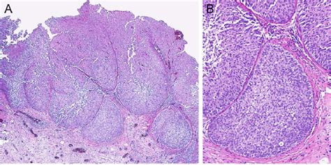 Papillary Urothelial Neoplasm Of Low Malignant Potential A The