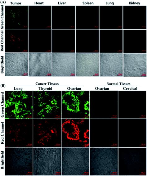 Dual Channel Fluorescence Diagnosis Of Cancer Cells Tissues Assisted By