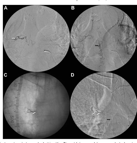 Figure 3 From Intramedullary Hemorrhage From A Thoracolumbar Dural