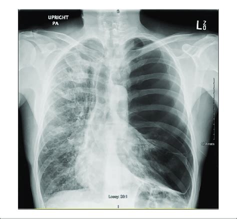 Upright Posterior Anterior Chest X Ray Demonstrates The Entire Left