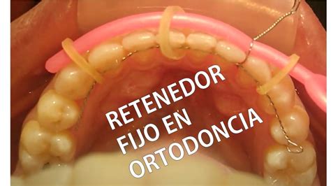 Retenedor Fijo En Ortodoncia Como Se Realiza Youtube