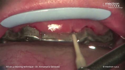 Tratamento De Peri Implantite Piezoel Trica Youtube