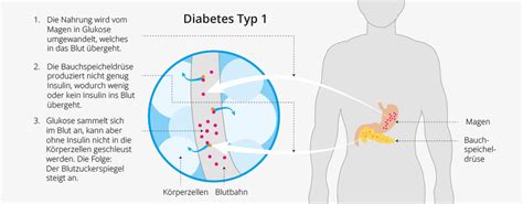 Ber K Rperzelle Anfragen Diabetes Mellitus Typ Bew Ltigung L Ndlich