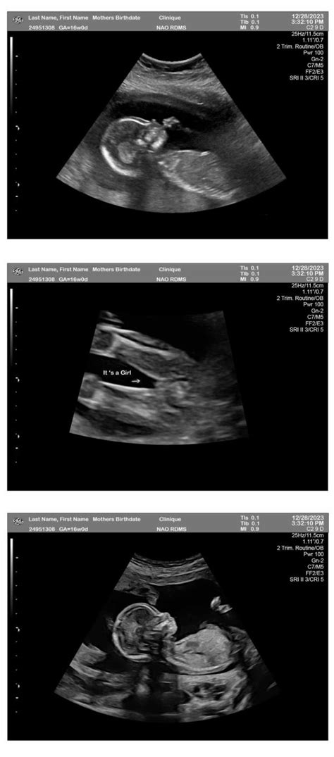 3 Fetuses 16 Weeks Ultrasound Girl Ultrasounds