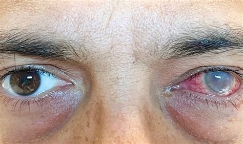 Endogenous Endophthalmitis Nejm