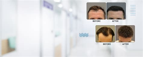 Best Hair Transplant Clinic In Dubai