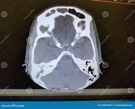 Sinusitis At Frontal Ethmoid Maxillary Sinus Film X Ray Of Skull