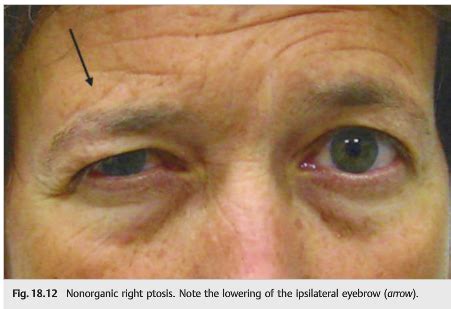 Neuro Ophthalmology Illustrated Chapter Nonorganic Neuro