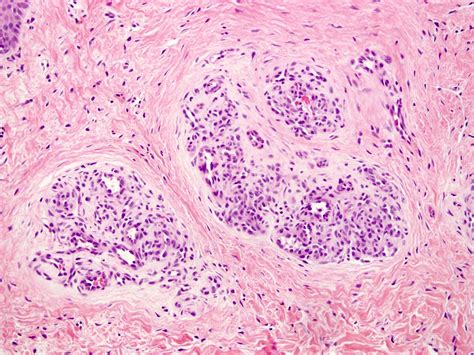 Pathology Outlines Glomus Tumor