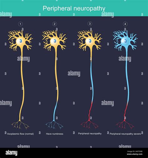 Sensory Neuropathy Stock Vector Images Alamy