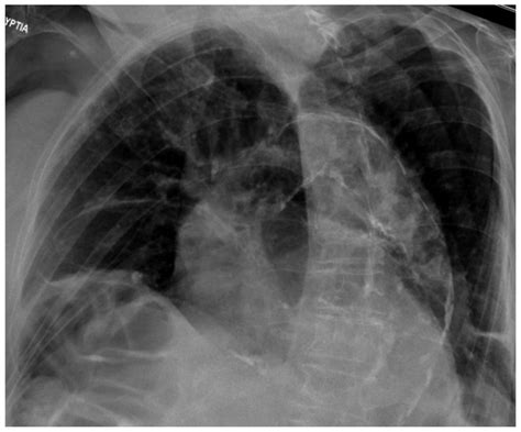 Chest X Ray Showing The Increased Cardiothoracic Ratio Calcification Download Scientific