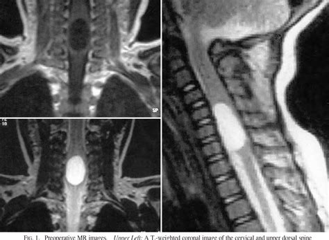 Figure 1 From Spinal Intramedullary Arachnoid Cyst In A 4 Year Old Girl