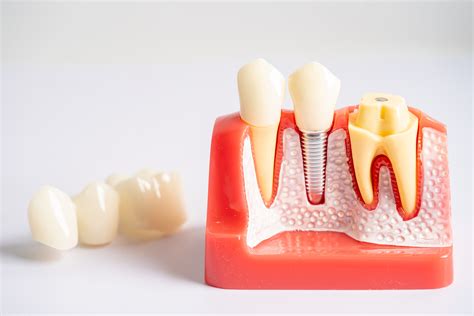 Dental Implants Procedure Timeline Steps To Your New Smile