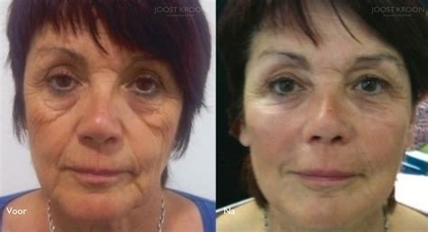 Botox Amsterdam Rimpelbehandeling Met Botox Joost Kroon