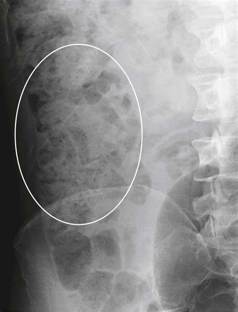 Recognizing the Normal Abdomen and Pelvis: Conventional Radiographs