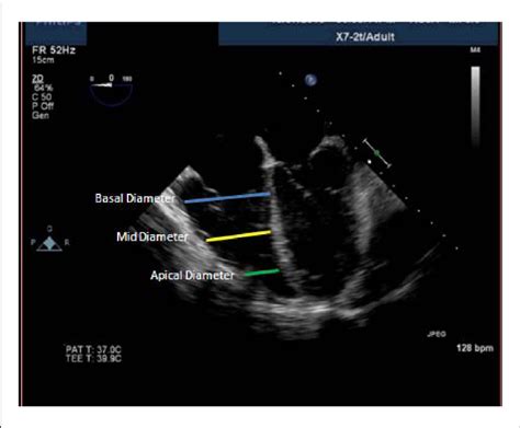 Two Dimensional Transesophageal Echocardiography Mid Esophageal Download Scientific Diagram