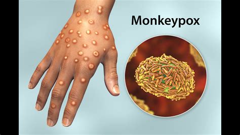 WHO expresses concern over monkeypox virus outbreak in Africa; do you ...