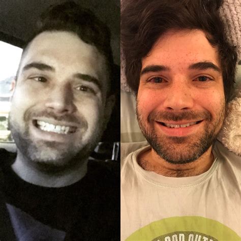 Before And After Picture Of My Strabismus Surgery Rhappy