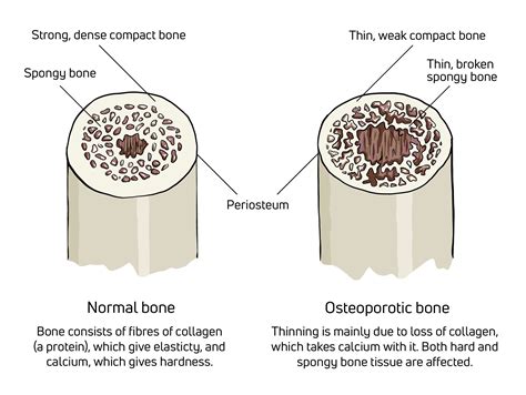 How A Back Brace Can Help Patients With Osteoporosis Enovis