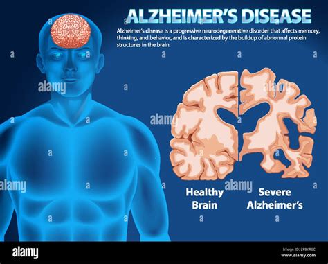 Informative Poster Of Alzheimers Disease Illustration Stock Vector