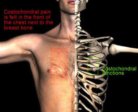 Best Costochondritis Images On Pinterest Costochondritis