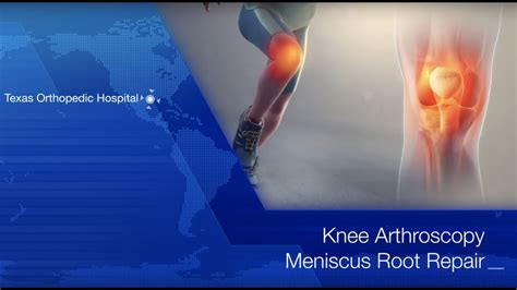 Medial Meniscus Root Repair Knee Arthroscopy By Dr Gombera Youtube