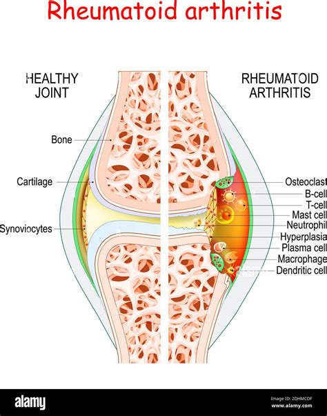 Rheumatoid Arthritis Healthy And Damage Joint Close Up Of Bone