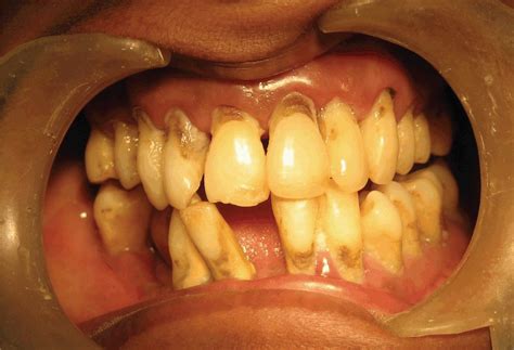 Full Text Periodontal Manifestations In A Patient With Psoriasis A Case Report