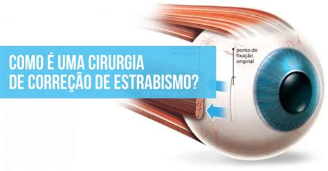 Plano de saúde cobre cirurgia de estrabismo Veja em qual caso é coberto