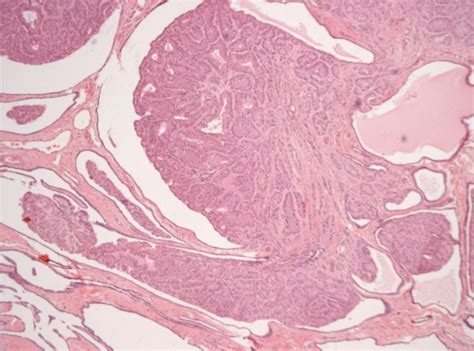 An Unexpected Finding Of A Rare Intrascrotal Lesion The Sertoliform