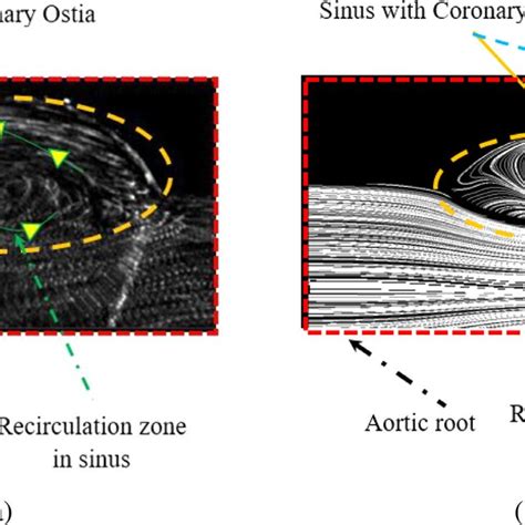 Pdf Fluid Structure Interaction Modelling Of Aortic Valve Stenosis